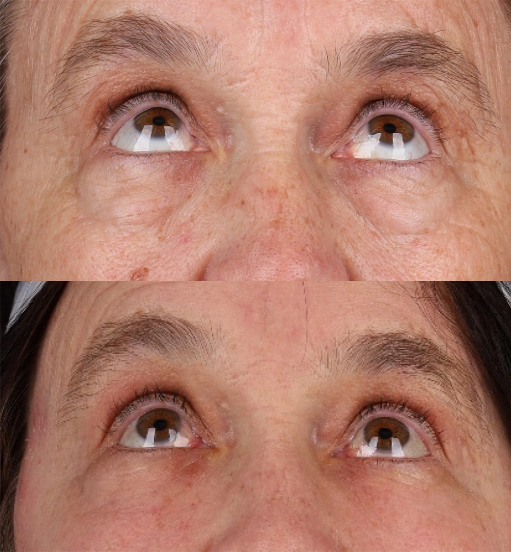 Real patient results before and after plastic surgery results in Beverly Hills, CA, performed by Dr. Moy