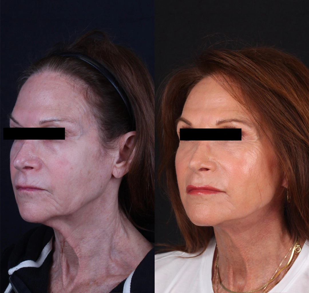 Real patient results before and after plastic surgery results in Beverly Hills, CA, performed by Dr. Moy