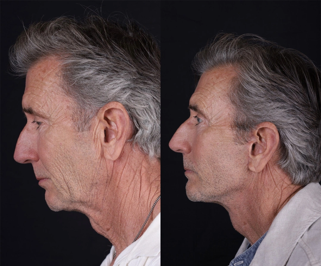 Real patient results before and after plastic surgery results in Beverly Hills, CA, performed by Dr. Moy