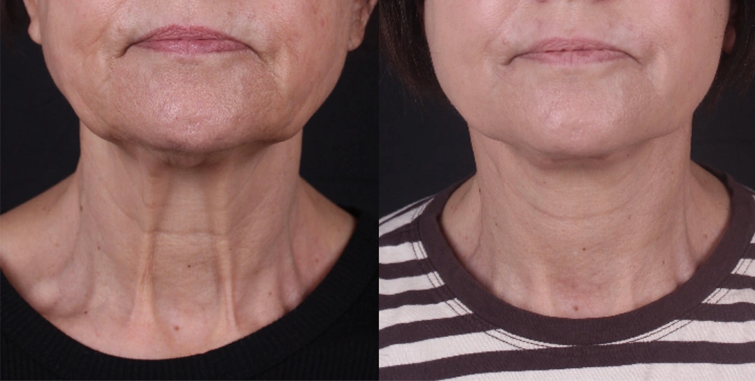 Real patient results before and after plastic surgery results in Beverly Hills, CA, performed by Dr. Moy