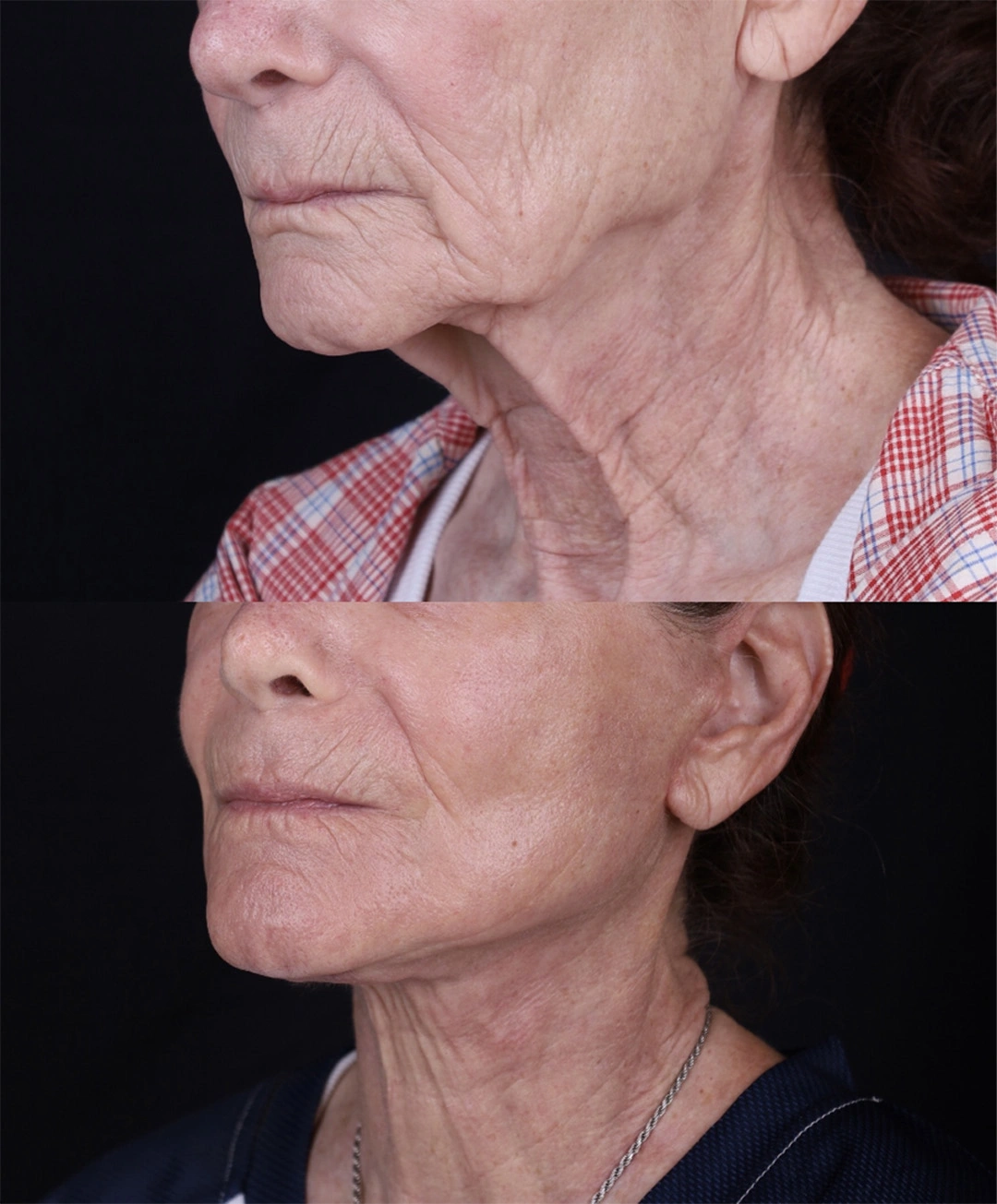 Real patient results before and after plastic surgery results in Beverly Hills, CA, performed by Dr. Moy