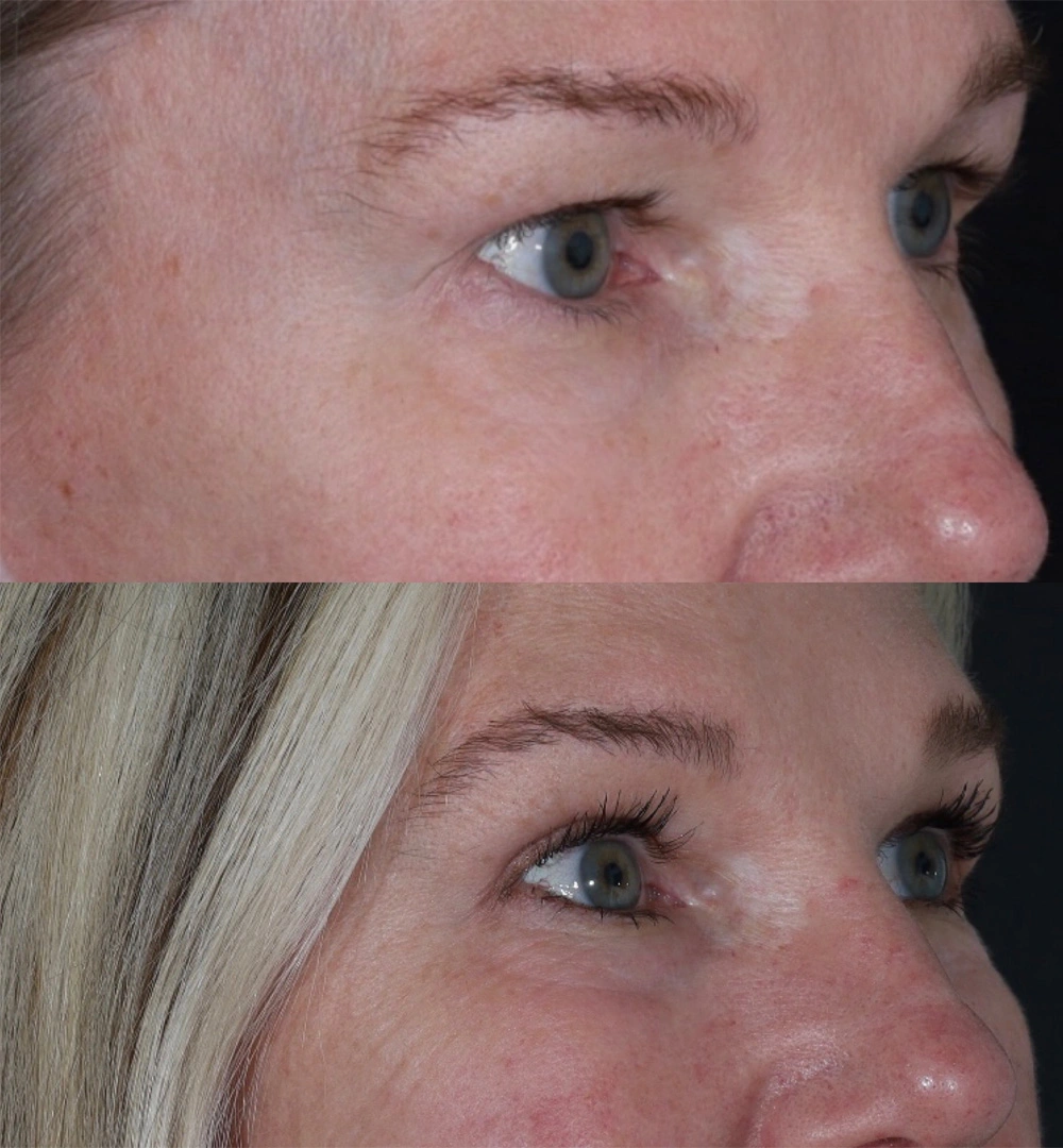 Real patient results before and after plastic surgery results in Beverly Hills, CA, performed by Dr. Moy