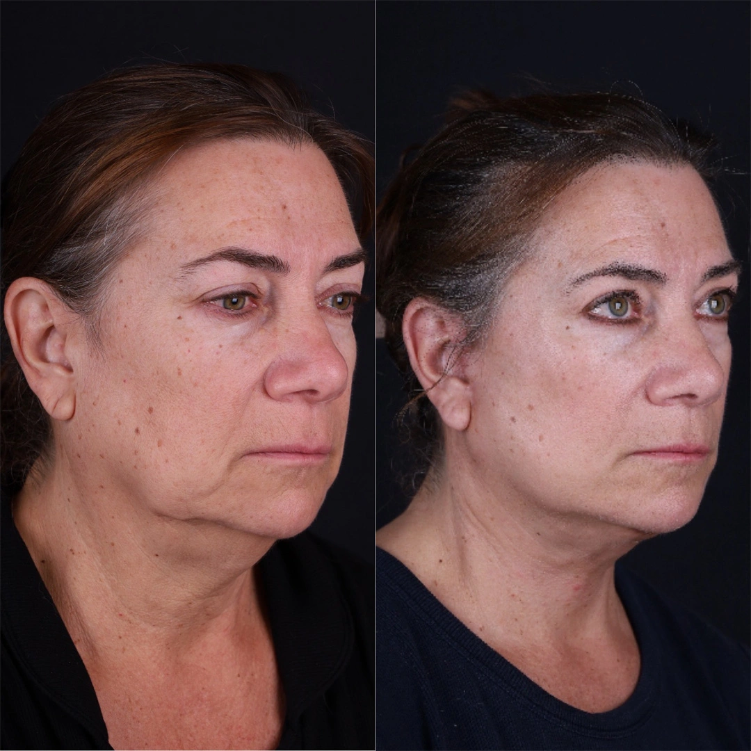 Real patient results before and after plastic surgery results in Beverly Hills, CA, performed by Dr. Moy