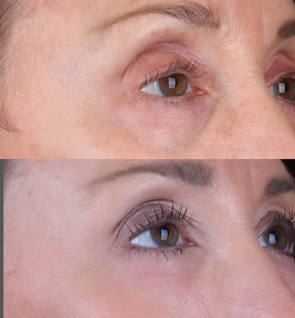 Real patient results before and after plastic surgery results in Beverly Hills, CA, performed by Dr. Moy