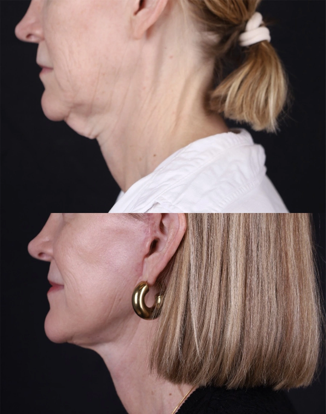 Real patient results before and after plastic surgery results in Beverly Hills, CA, performed by Dr. Moy
