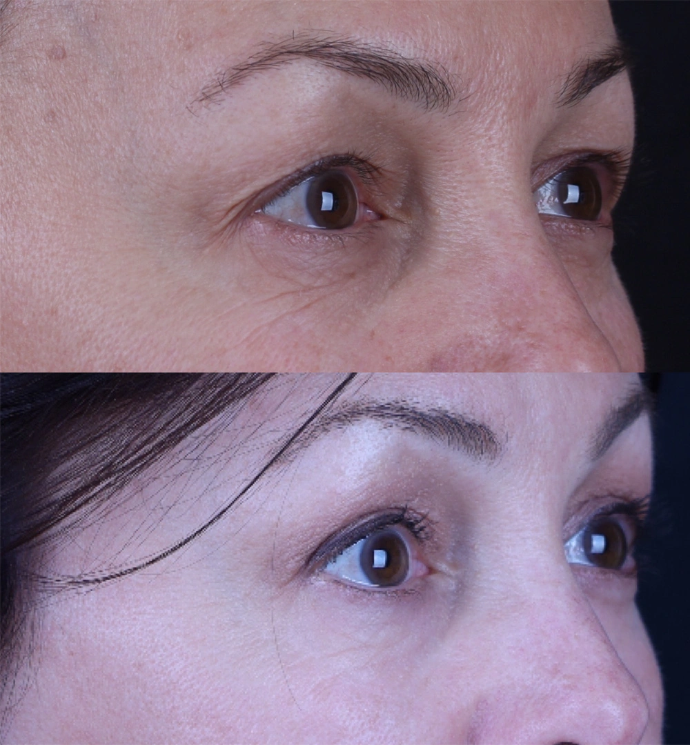Real patient results before and after plastic surgery results in Beverly Hills, CA, performed by Dr. Moy