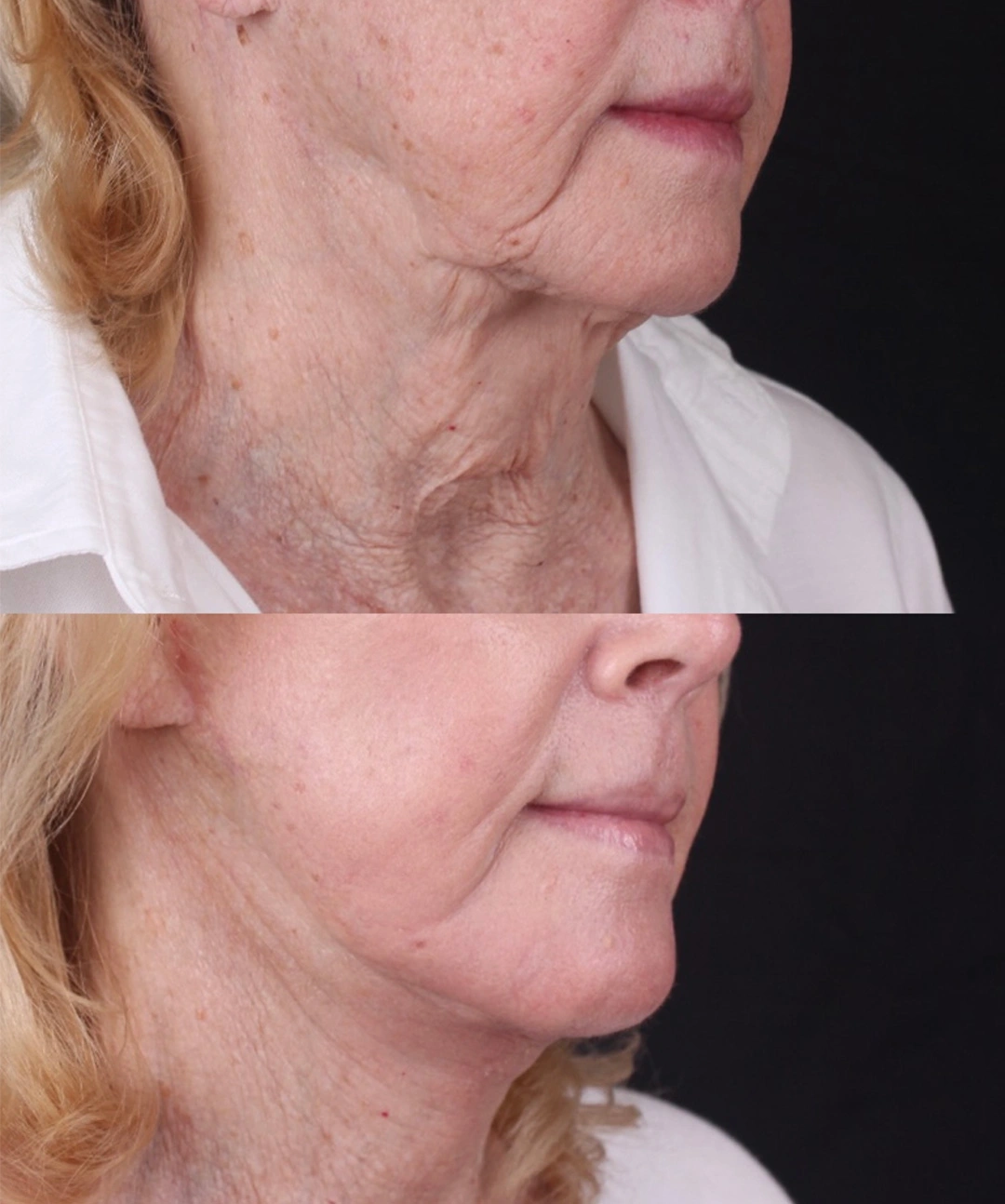 Real patient results before and after plastic surgery results in Beverly Hills, CA, performed by Dr. Moy