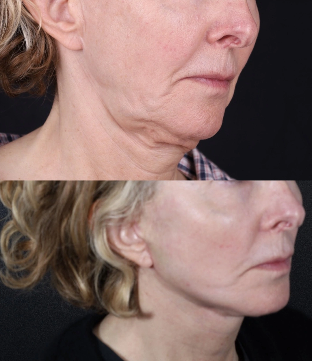 Real patient results before and after plastic surgery results in Beverly Hills, CA, performed by Dr. Moy