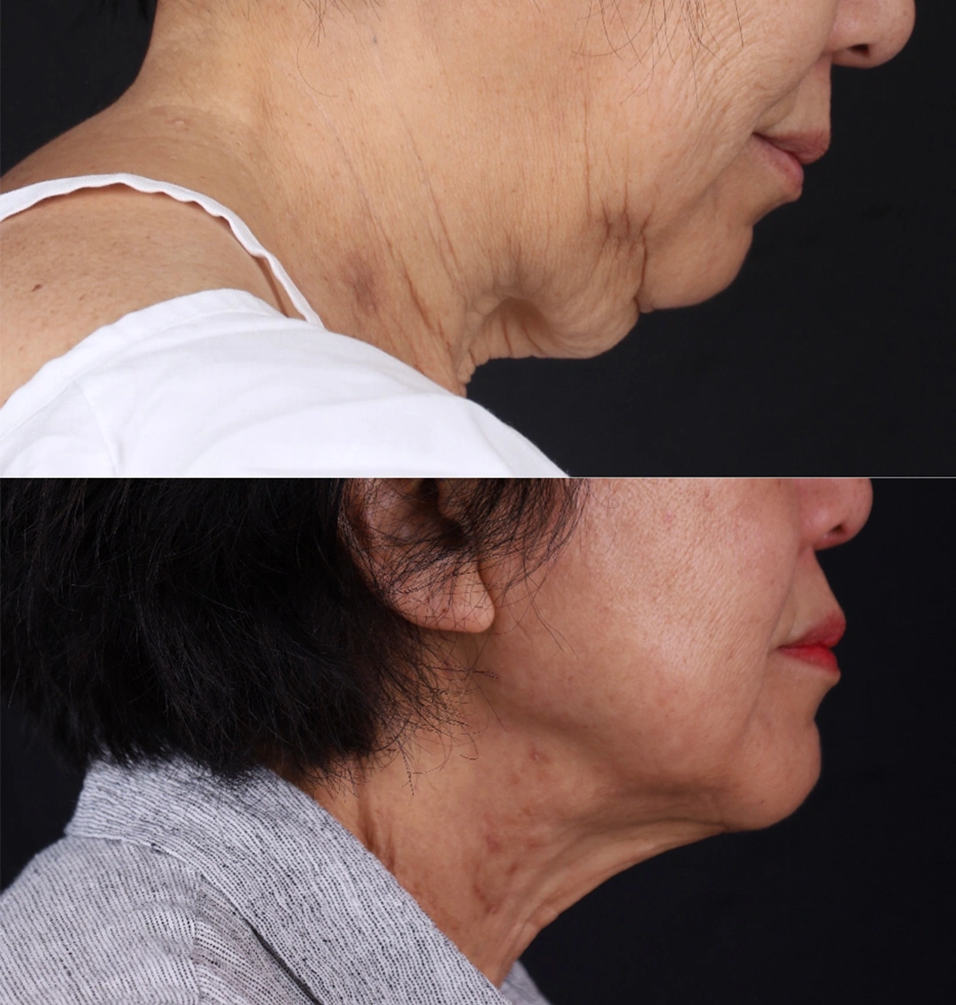 Real patient results before and after plastic surgery results in Beverly Hills, CA, performed by Dr. Moy
