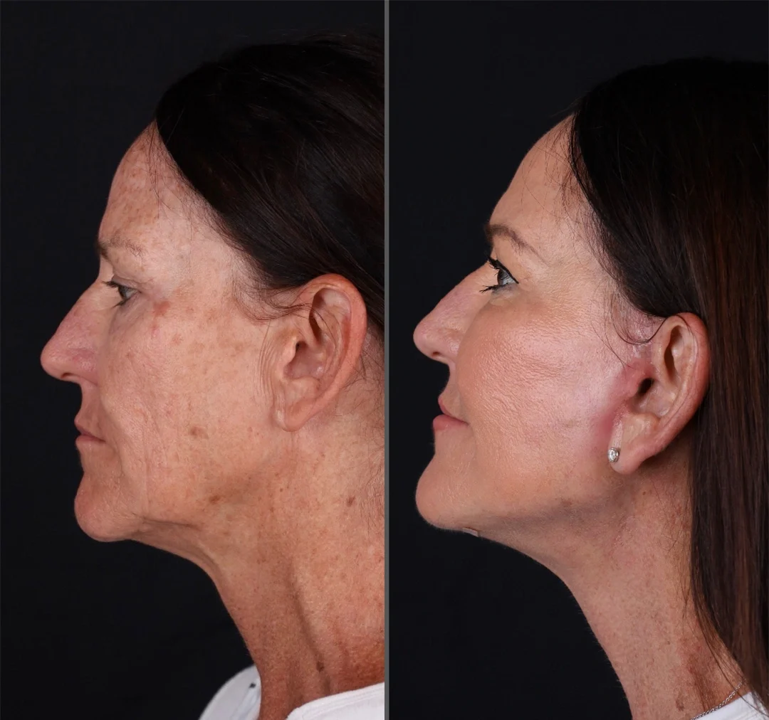 Real patient results before and after plastic surgery results in Beverly Hills, CA, performed by Dr. Moy
