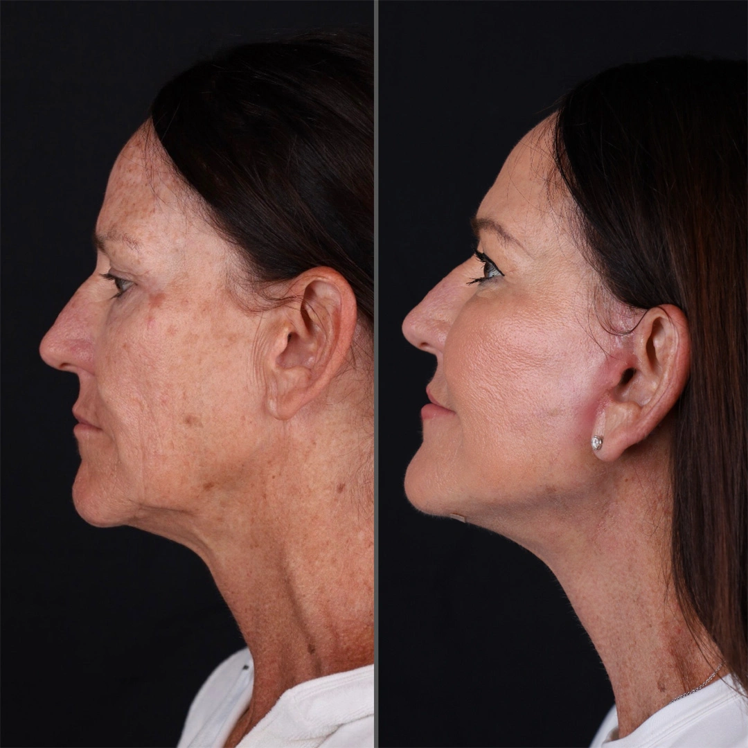 Real patient results before and after plastic surgery results in Beverly Hills, CA, performed by Dr. Moy