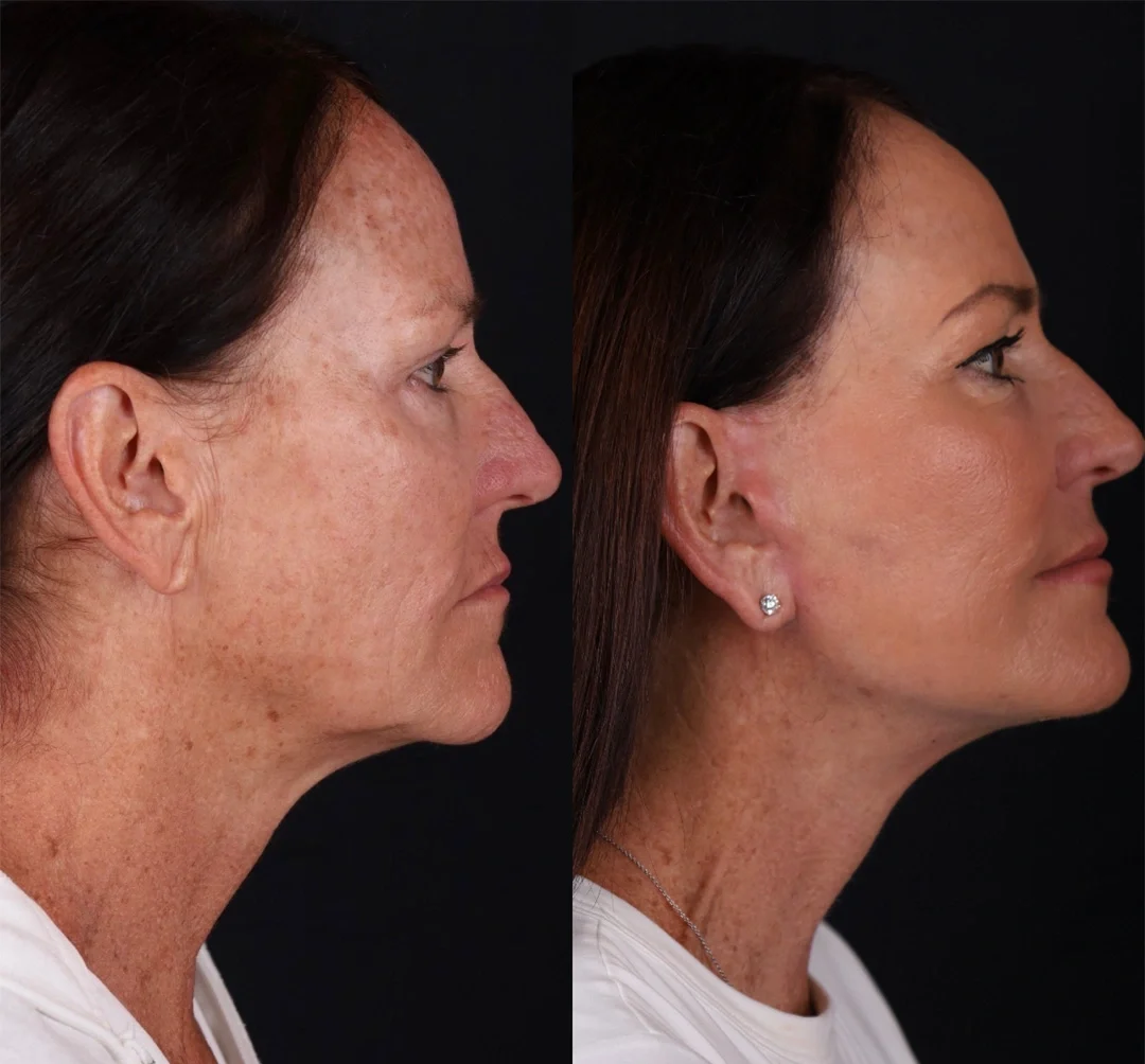 Real patient results before and after plastic surgery results in Beverly Hills, CA, performed by Dr. Moy
