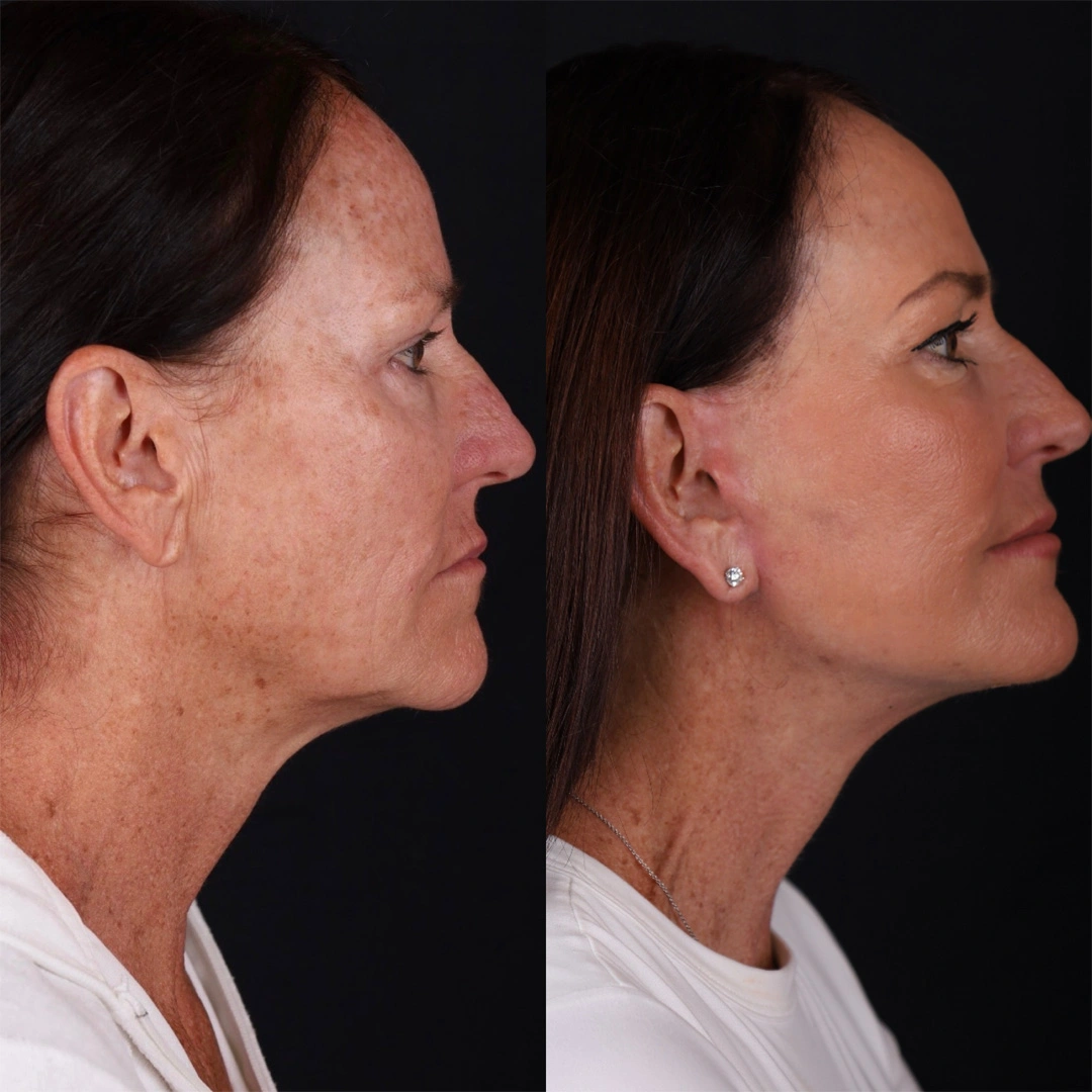 Real patient results before and after plastic surgery results in Beverly Hills, CA, performed by Dr. Moy