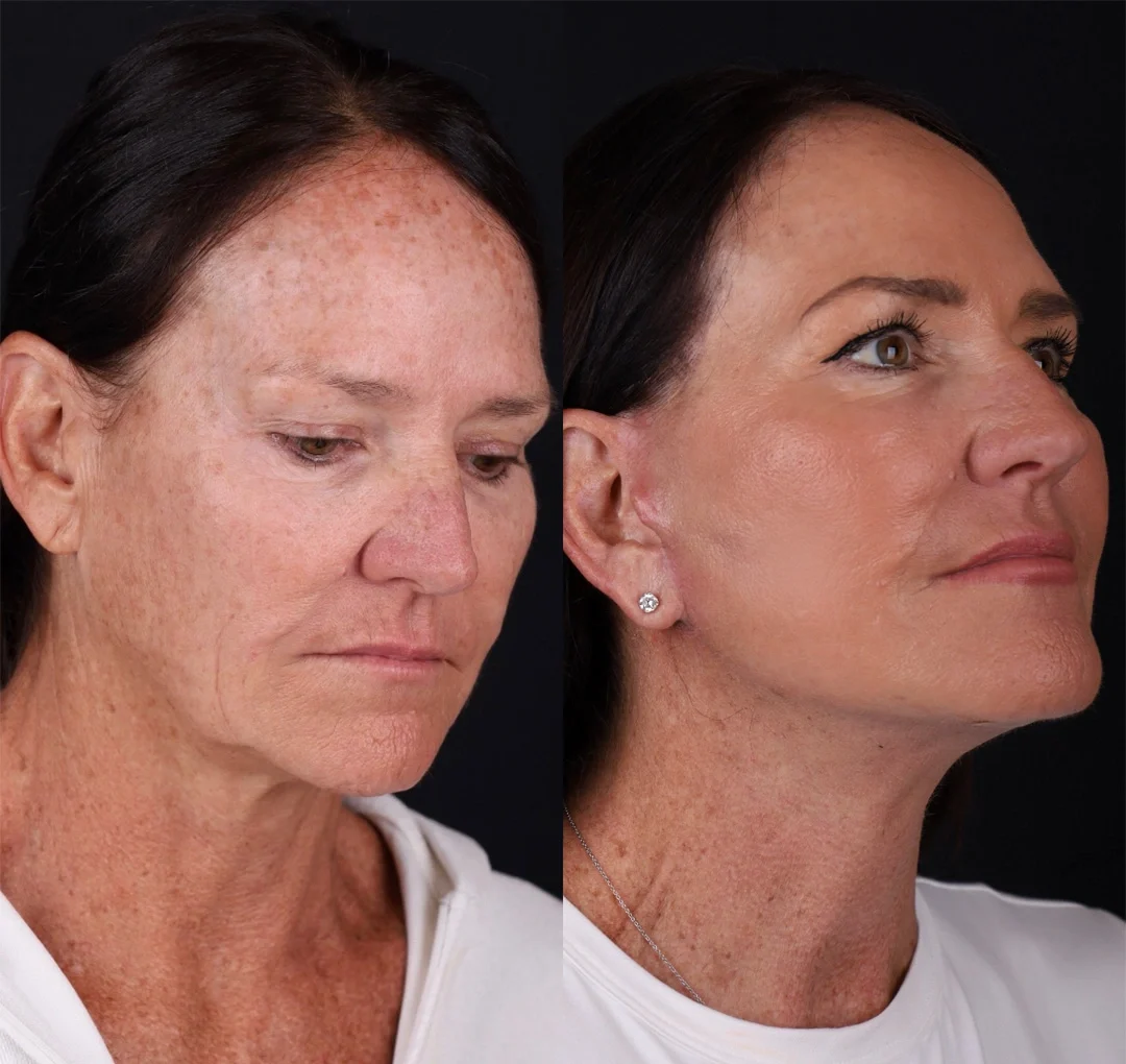 Real patient results before and after plastic surgery results in Beverly Hills, CA, performed by Dr. Moy