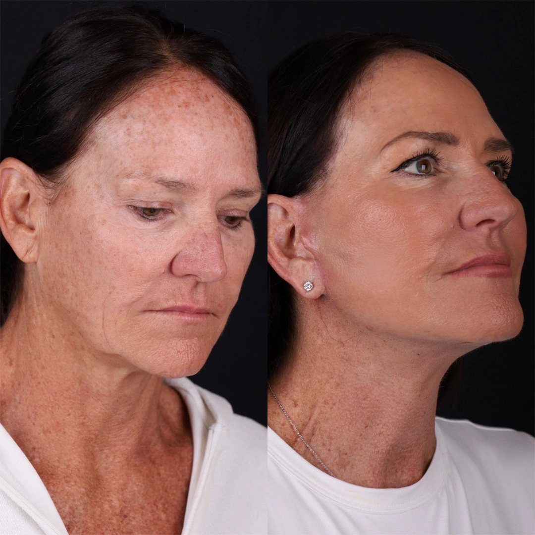 Real patient results before and after plastic surgery results in Beverly Hills, CA, performed by Dr. Moy