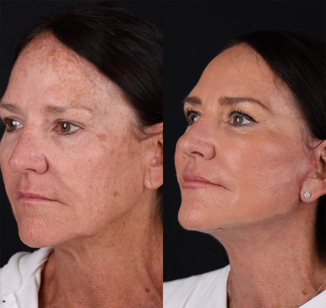 Real patient results before and after plastic surgery results in Beverly Hills, CA, performed by Dr. Moy
