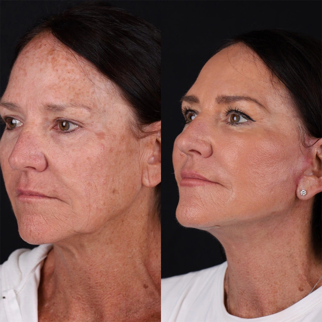 Real patient results before and after plastic surgery results in Beverly Hills, CA, performed by Dr. Moy