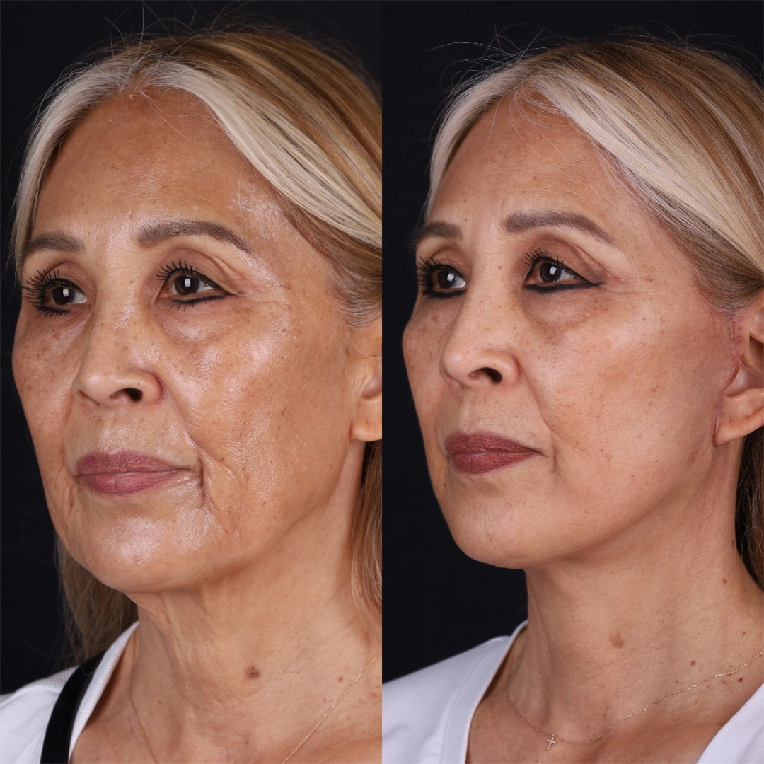 Real patient results before and after plastic surgery results in Beverly Hills, CA, performed by Dr. Moy
