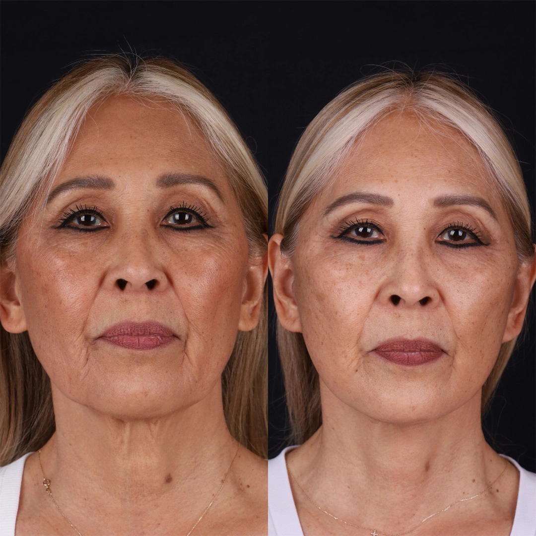 Real patient results before and after plastic surgery results in Beverly Hills, CA, performed by Dr. Moy