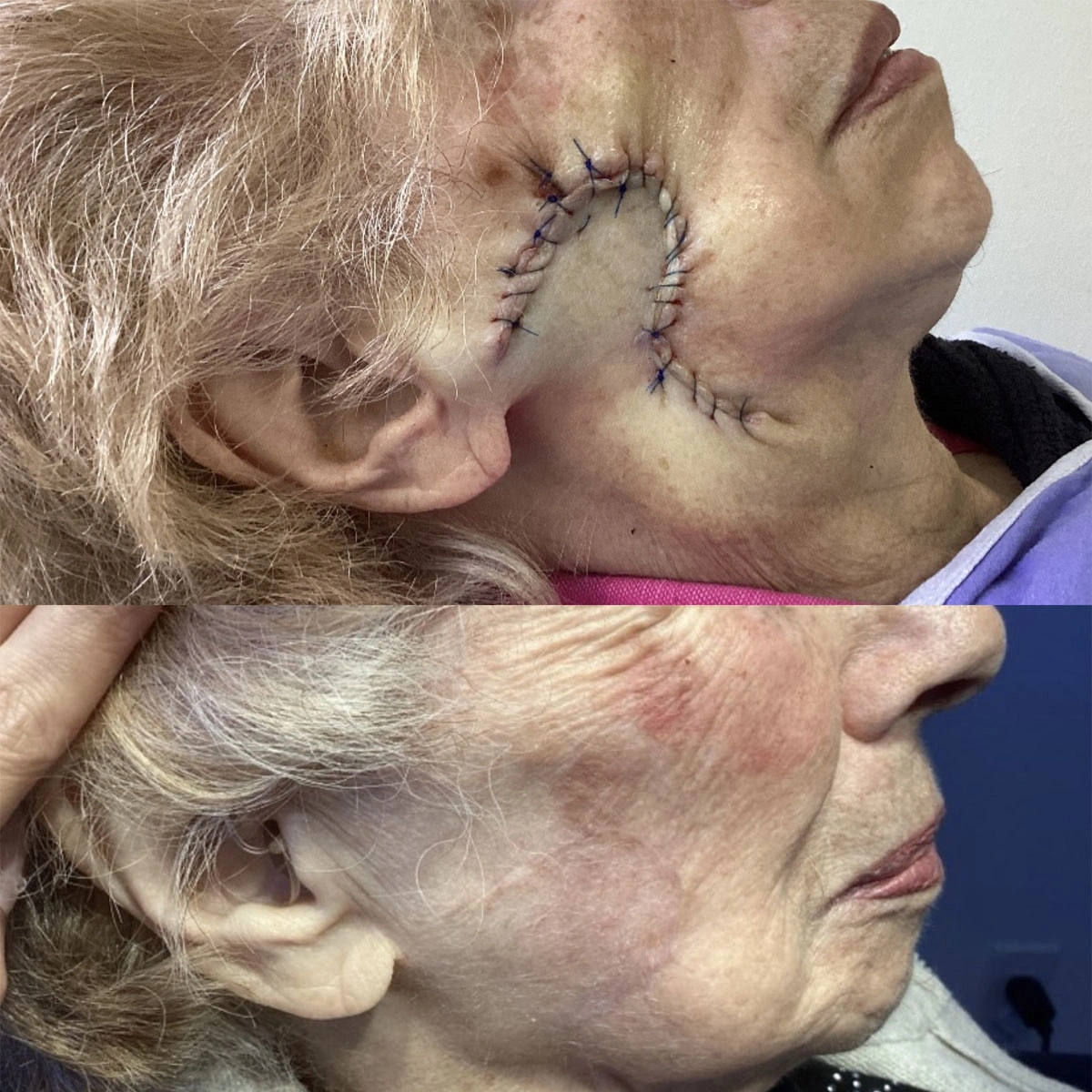 Real patient results before and after plastic surgery results in Beverly Hills, CA, performed by Dr. Moy